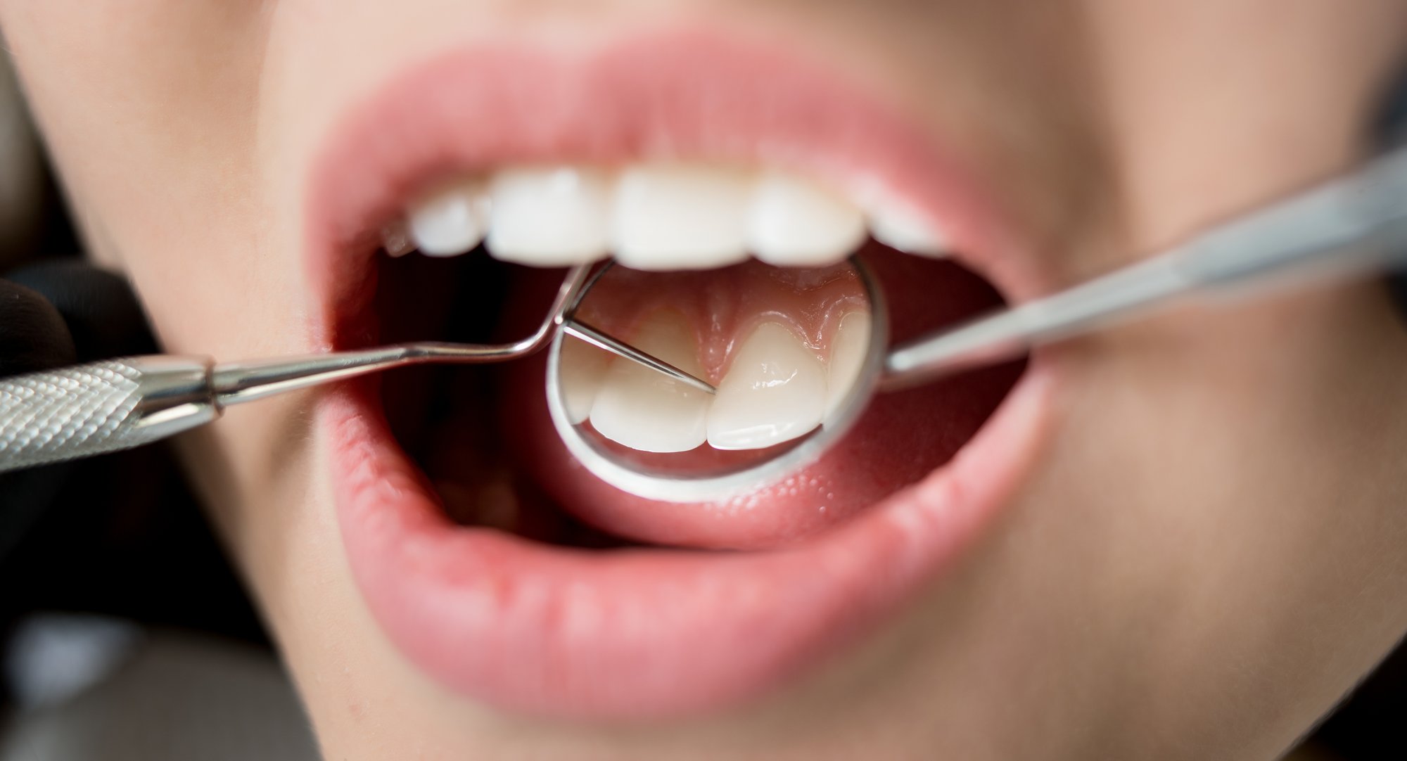 Is It Normal for My Gums to Recede With Age?